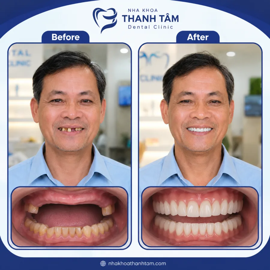 Ảnh minh hoạ trước & sau 4