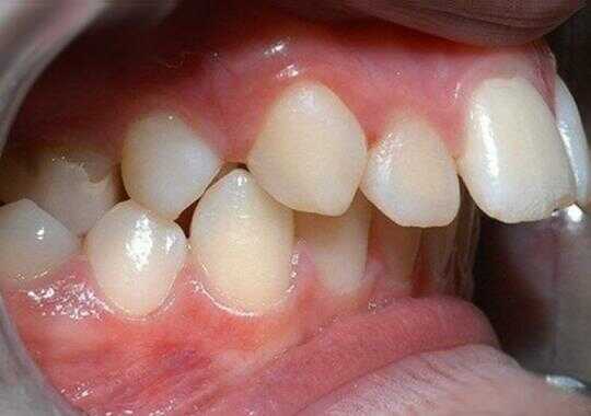 hô răng và hô hàm