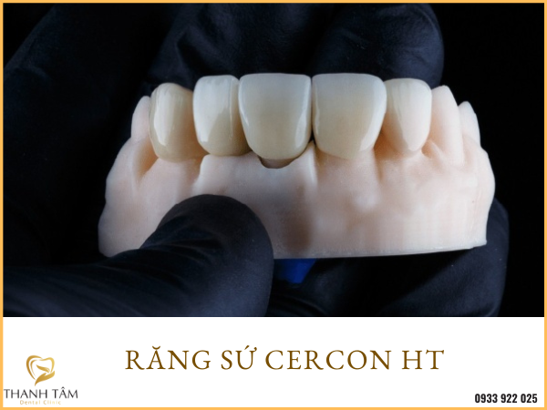 Có những mẹo nào giúp chọn màu sắc cho răng sứ Cercon HT dễ dàng hơn?

