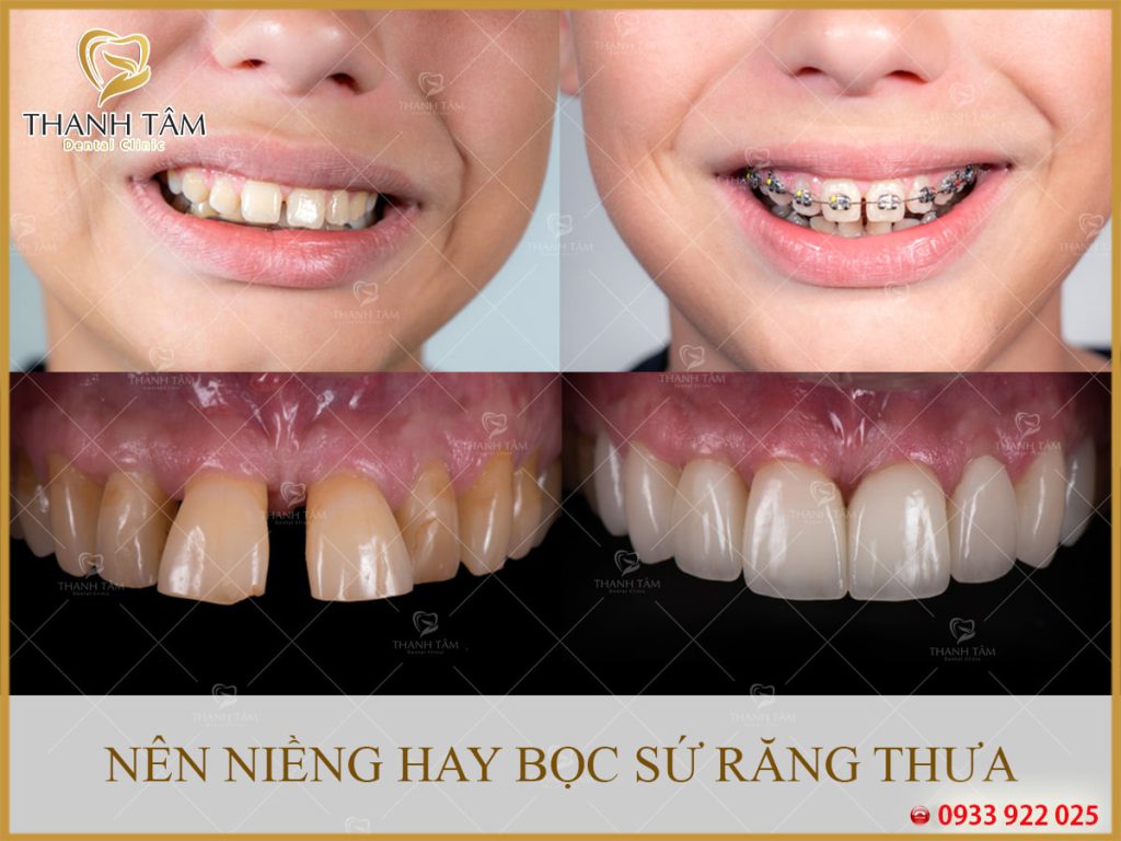 Nên niềng hay bọc sứ răng thưa