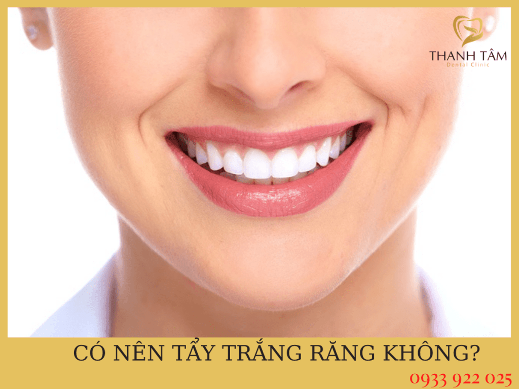 Những lưu ý khi tẩy trắng răng