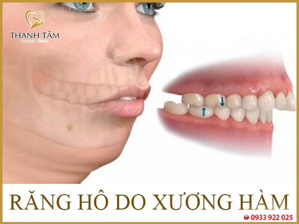 Xương ổ răng