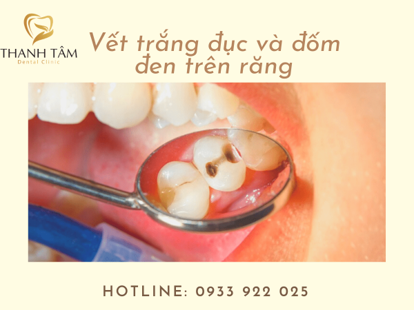 Vết trắng đục và đốm đen trên răng