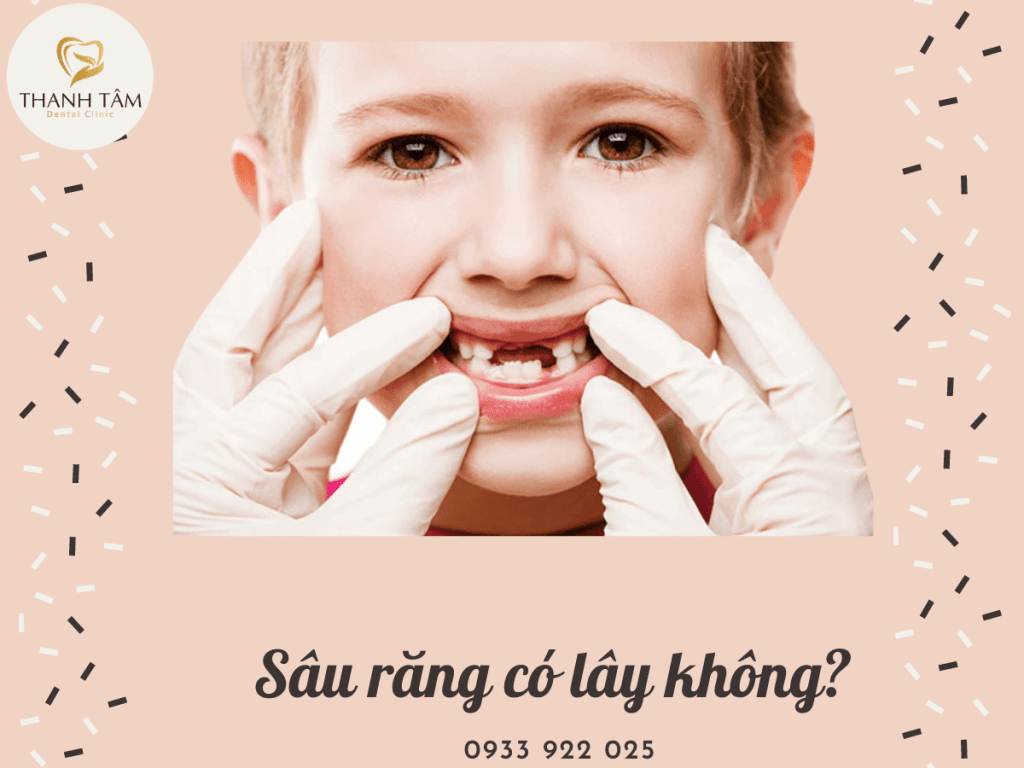 Sâu răng có lây không