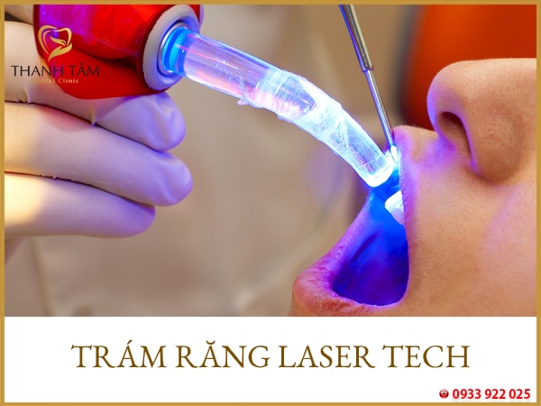 trám răng laser tech