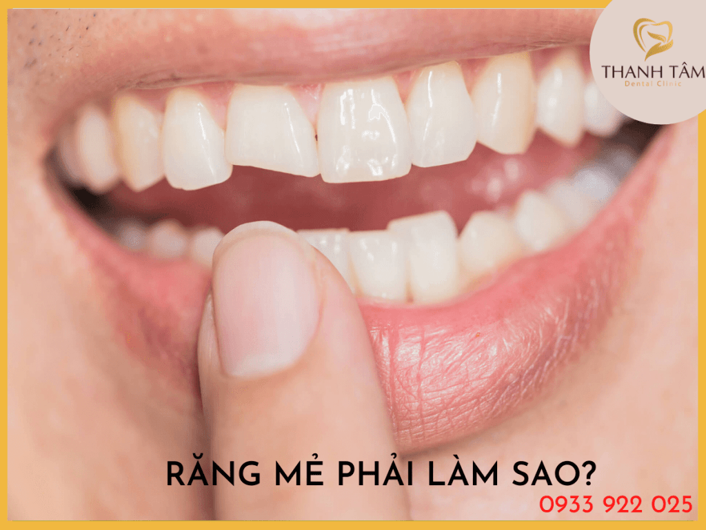 Răng mẻ phải làm sao?