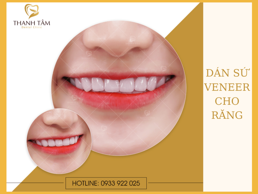 Dán Veneer cho răng