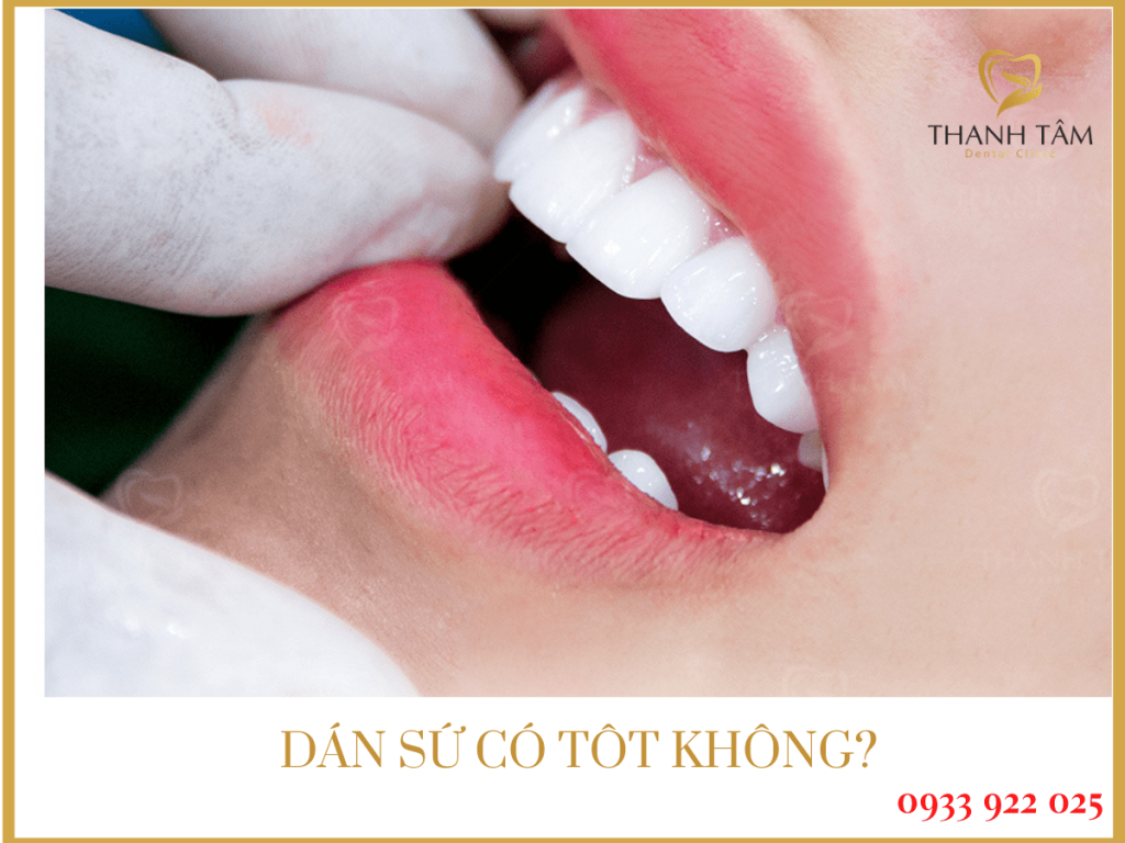 Dán sứ có tốt không?