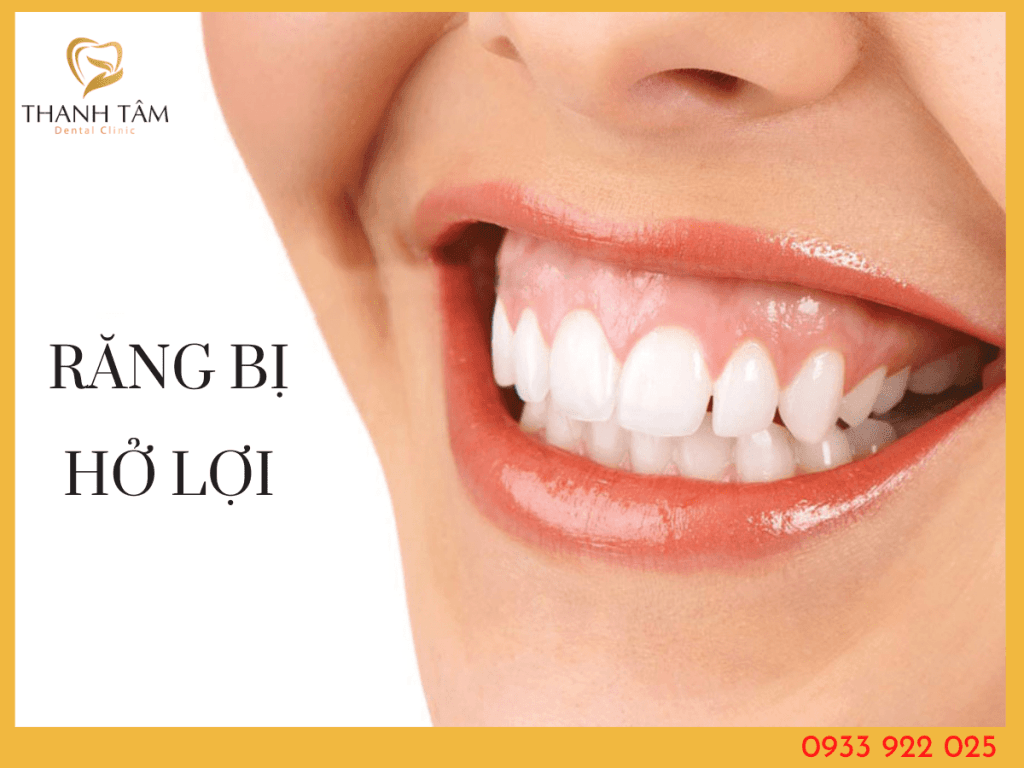 Răng bị hở lợi