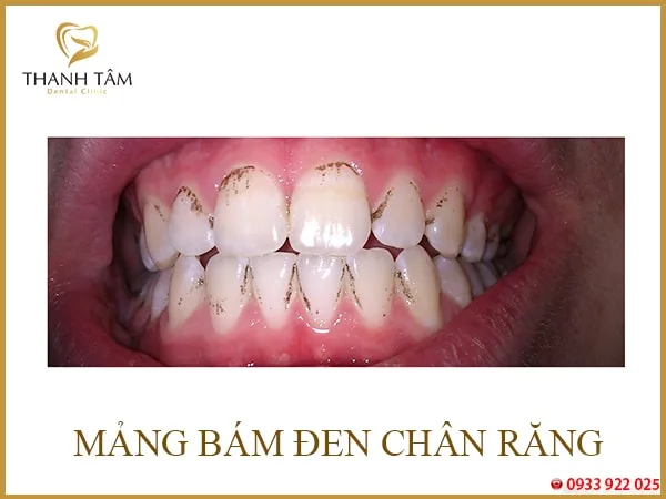 Mảng bám đen chân răng