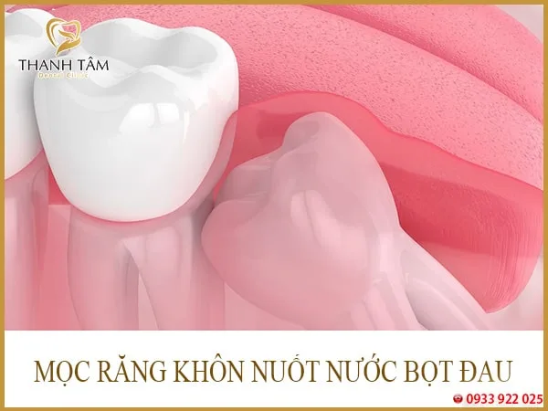 Mọc răng khôn nuốt nước bọt đau