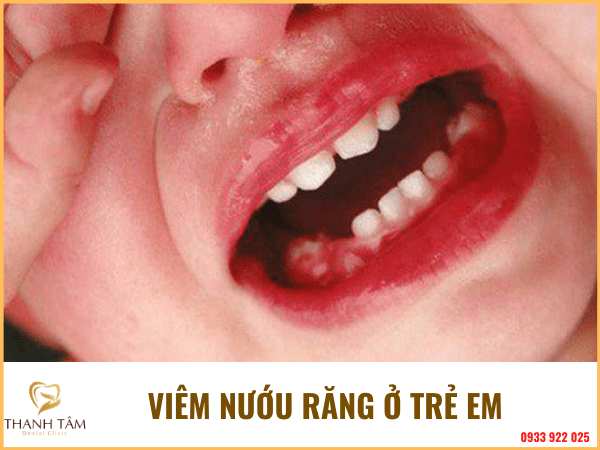 viêm nướu răng ở trẻ