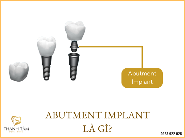 abutment implant