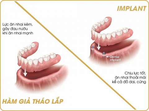 so sánh răng tháo lắp và implant-2