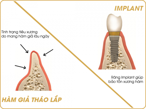 so sánh răng tháo lắp và implant-3