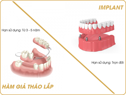 so sánh răng tháo lắp và implant-1